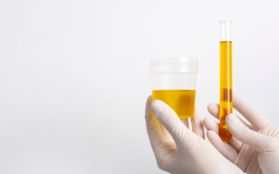 Jakie są objawy wysokiego poziomu kwasu moczowego?