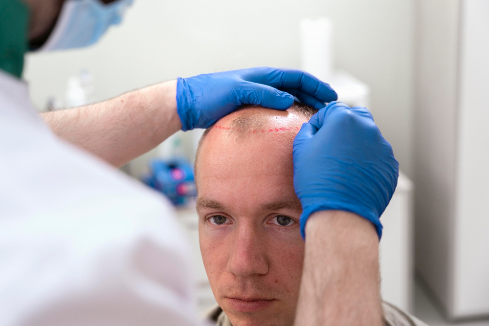 Ile kosztuje przeszczep włosów u mężczyzn?